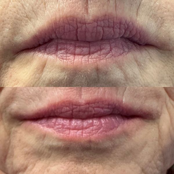 before and after of perioral lines treated with filler