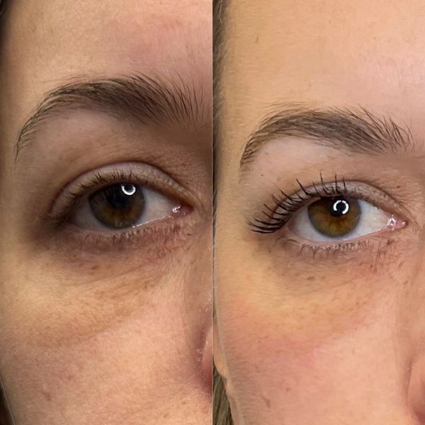 before and after of Under eye filler and PDO threads