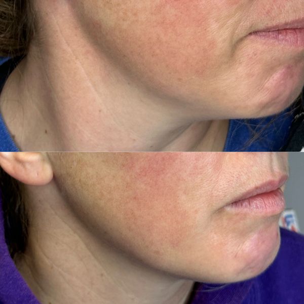before and after of jawline/submental area treated with PDO threads