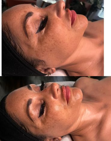Glow Getter Microdermabrasion Treatment