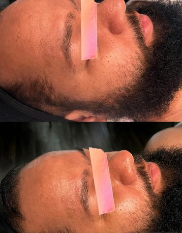 Glow Getter Microdermabrasion Treatment