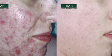 Before & after of DMK enzyme therapy  for mild to severe hormonal, cystic & acne rosacea.