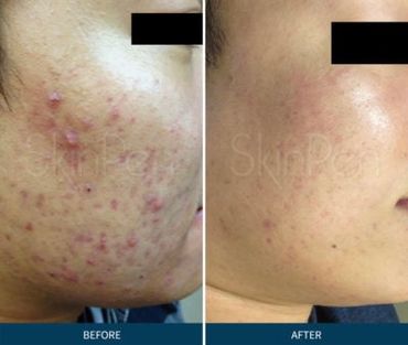 A woman with acne and acne scarring which healed up better with SkinPen Microneedling.