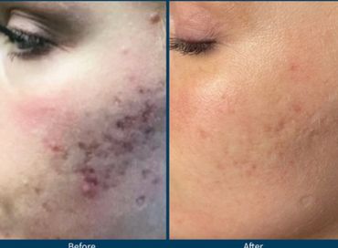 SkinPen microneedling treatment for red acne scarring or post inflammatory erythema from acne scar