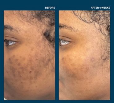 A black woman with post inflammatory hyperpigmentation from acne scarring who had SkinPen