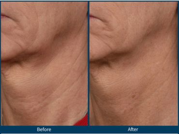 Wrinkles of a woman which got better with SkinPen Microneedling treatment.