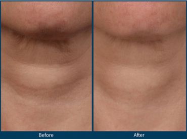 Tech Neck wrinkles of a woman who got better with SkinPen Microneedling