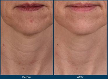 Before & after of a woman with chin & neck wrinkles who had SkinPen microneedling