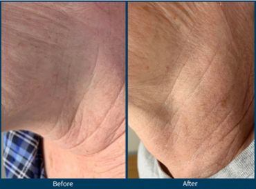 neck wrinkle of a man which got better from SkinPen microneedling