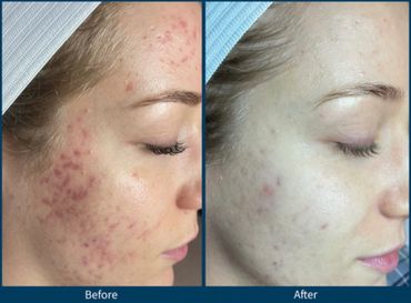 A girl with acne and acne scarring and had SkinPen microneedling treatment .