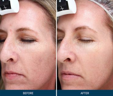 Before & after of a woman with sun damage that got better with SkinPen microneedling.
