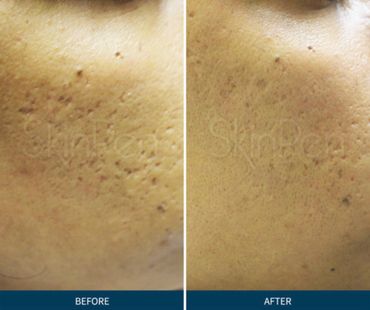 SkinPen Microneedling treatment for Ice pick scar, box scar, pitted scar or atrophic scar