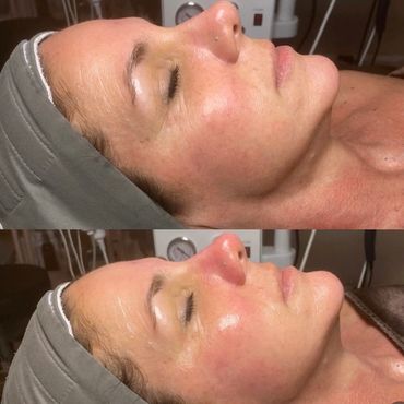 Before and after of a woman who had a beautiful and glowing skin after HydraFacial