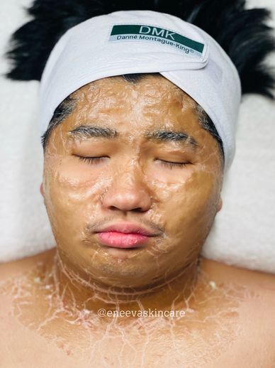 A teen having DMK Enzyme Therapy treatment for melasma, psoriasis, eczema, skin lightening