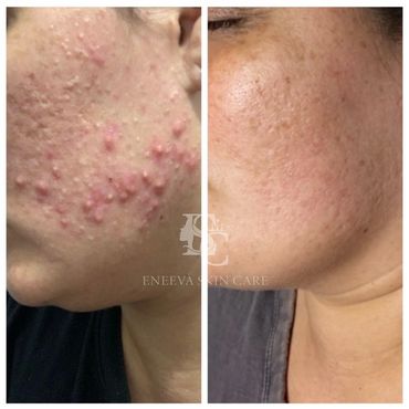 before & after of a woman with hormonal, inflamed & non inflamed acne.