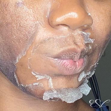 A woman who had done a custom chemical peel for hyperpigmentation from acne and sun damaged.