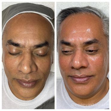 HydraFacial Treatment for fine lines & wrinkles, dry skin, brightens skin, improves skin elasticity