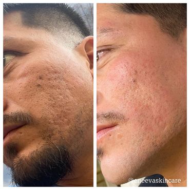 Before and after of a man who had ProCell Therapies Microchanneling done on pitted scars & box scar.