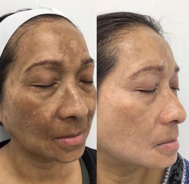 Before and after of a lady who's melasma got better with Cosmelan MD