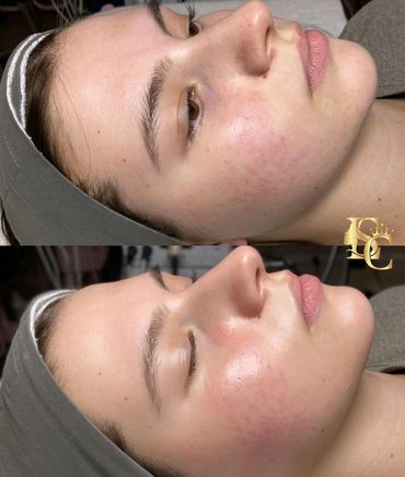 A lady with a lot of peach fuzz or facial hair and had dermaplaning