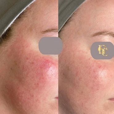 Woman with rosacea and telangiectasia or broken capillaries who had IPL or intense pulse light.