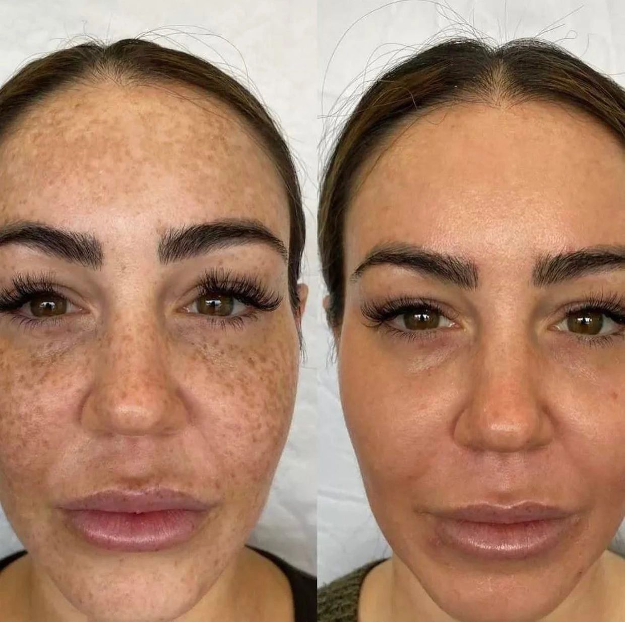 Before and after of a woman with melasma or sun damaged & had Cosmelan MD