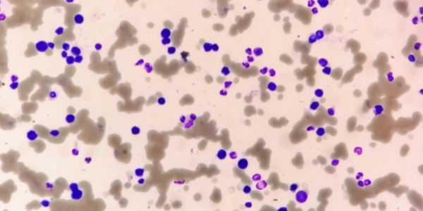 Photomicrograph of blood film, plasma cell leukemia, plenty atypical cells, rouleaux formation.
