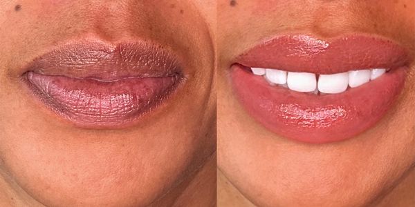 Before and after of lip neutralization showing how the pigment changes the colour of darker lip tone