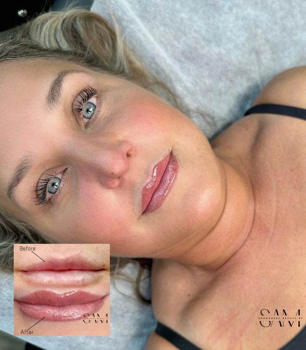 Correcting lip shape