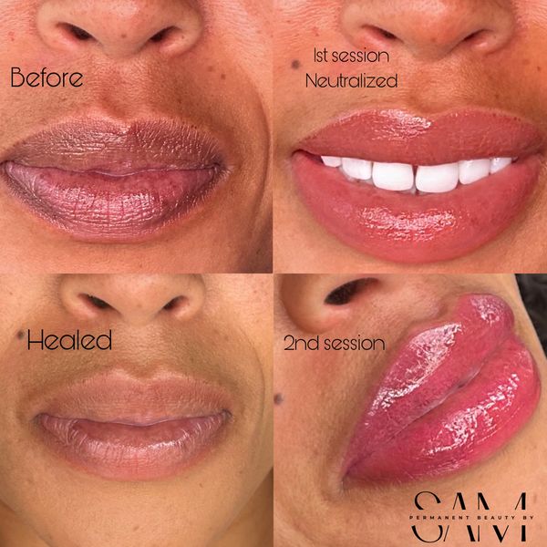 Before after healed and second session of lip neutralization