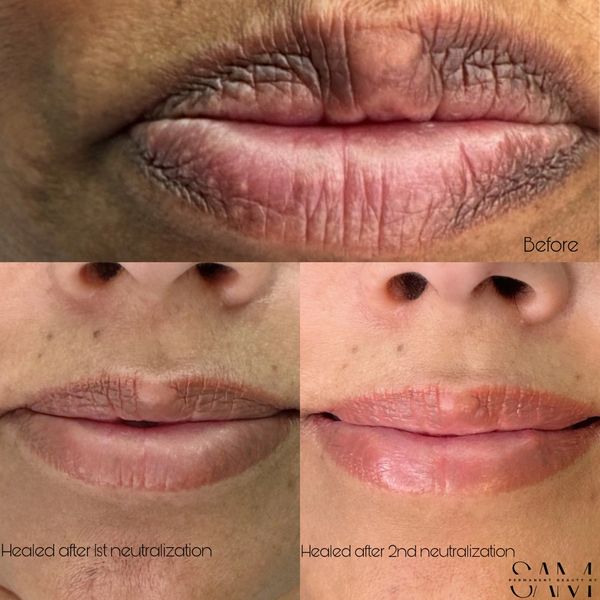 Lip neutralization