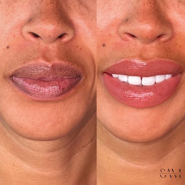 Lip neutralization on melanin rich skin