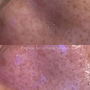 Large pores and congestion