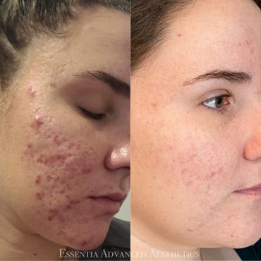 Acne and scarring