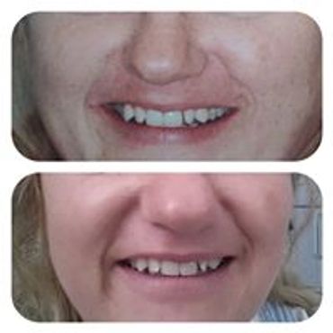 Microdermabrasion treatments