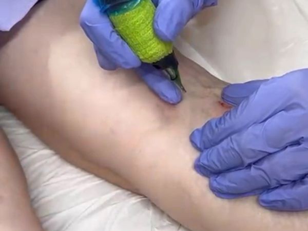 Person getting a tattoo on their leg.