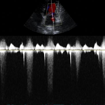 Continuous wave Doppler ultrasound image during echocardiogram examination