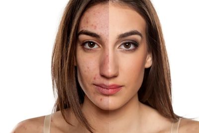 Photo showing a woman's Acne - before and after