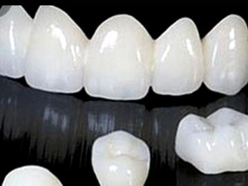 Close-up of white dental crowns on a reflective black surface.
