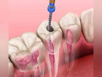 Dental procedure drilling into a tooth for root canal treatment.