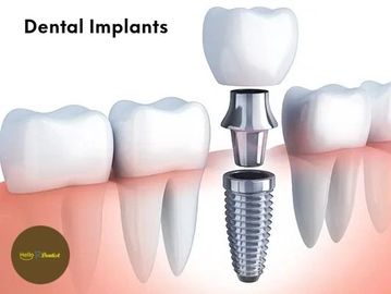 Illustration showing a dental implant replacing a missing tooth.