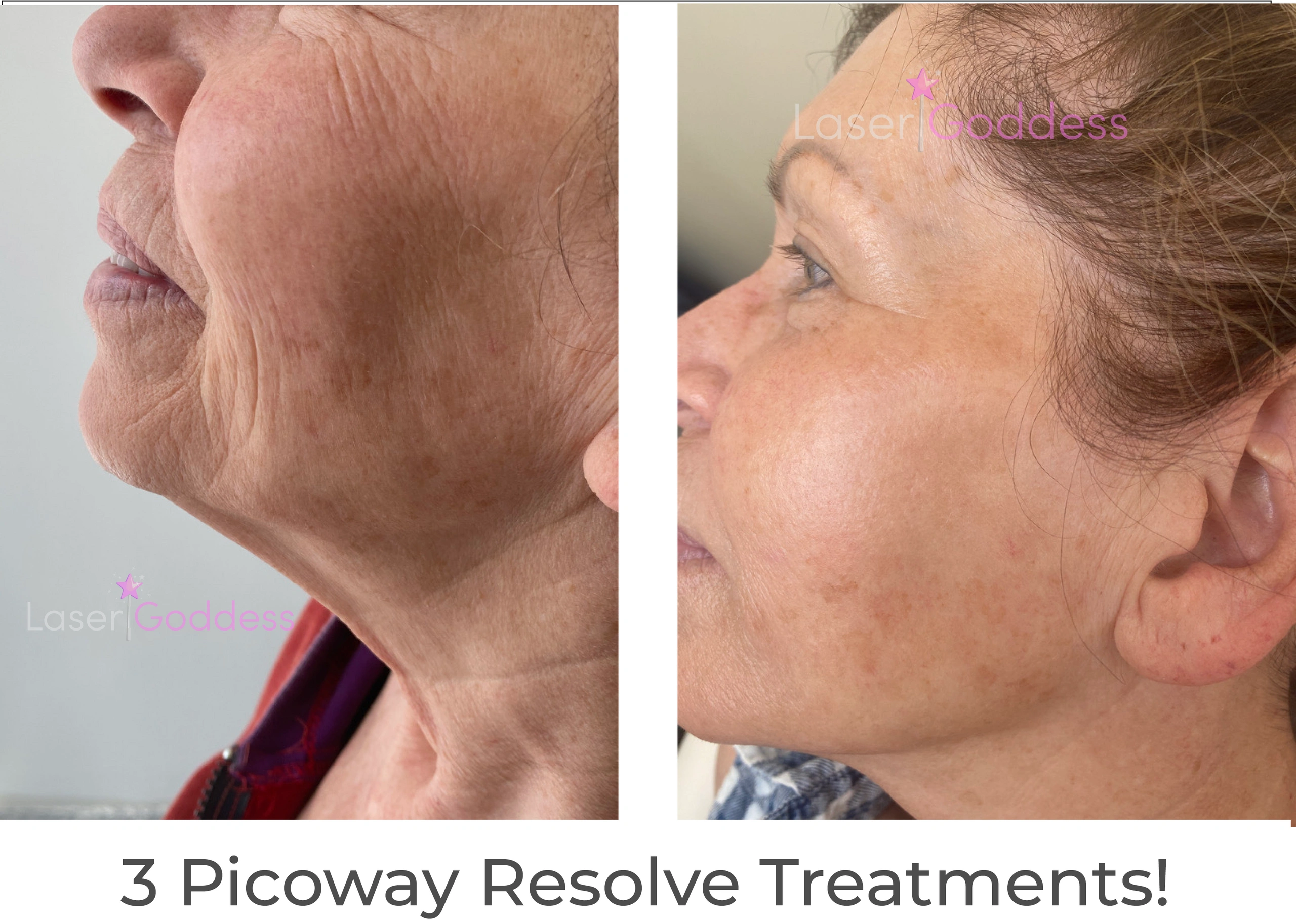This client had 3 Picoway Resolve treatments over a 6 month period