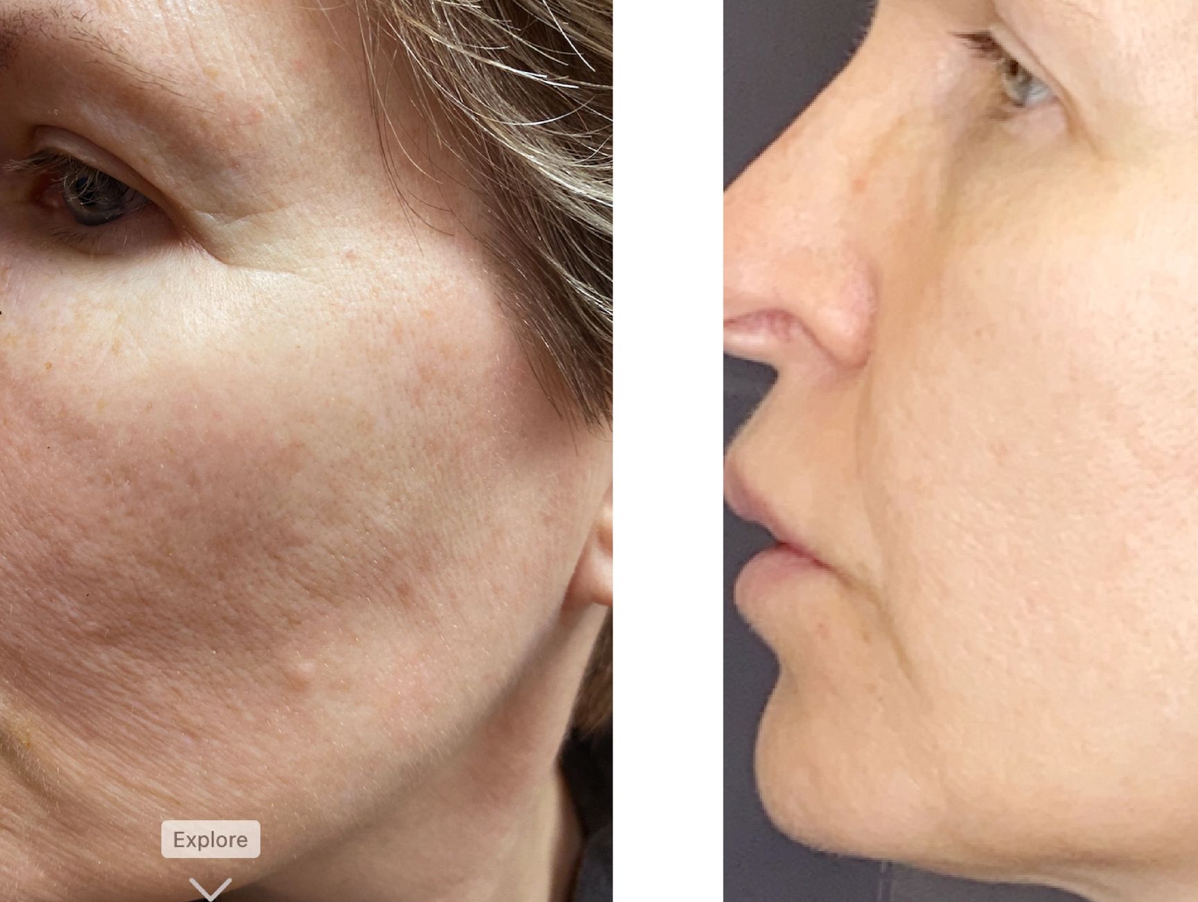 Picoway Resolve tightened up the skin on this 53 year old woman. 