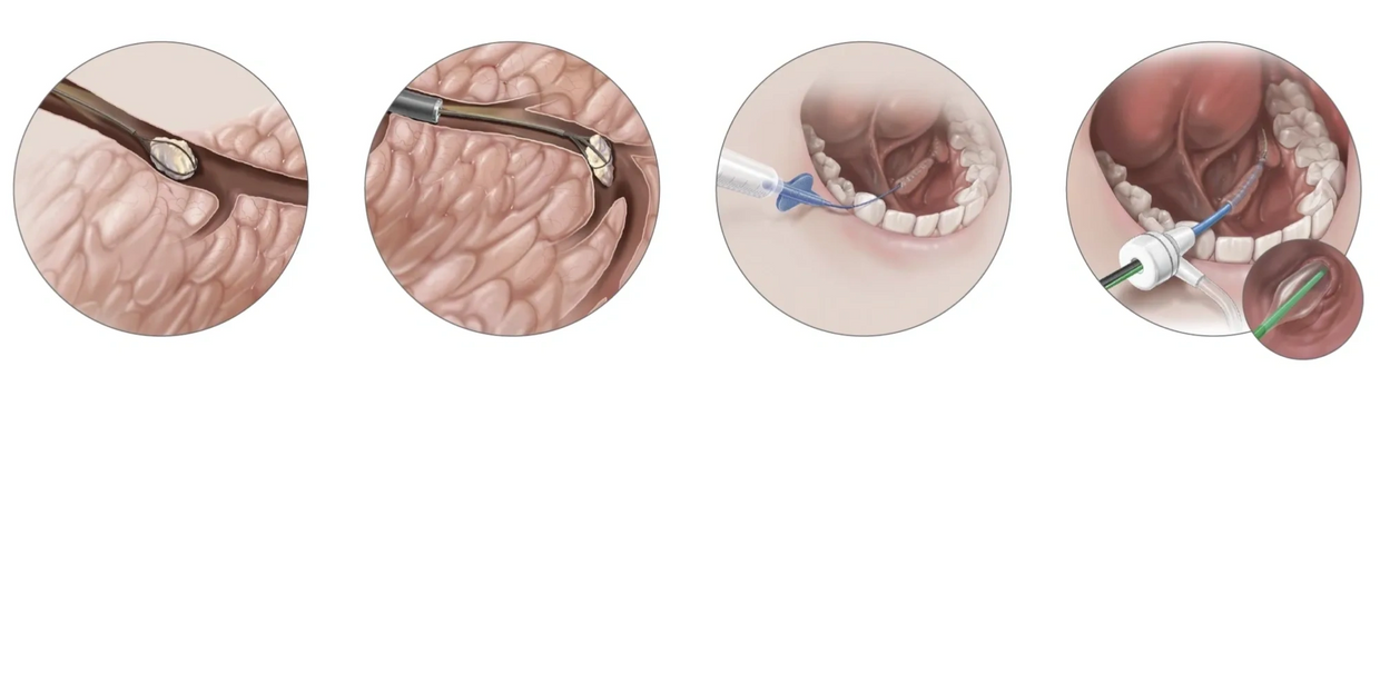 Sialendoscopy procedure