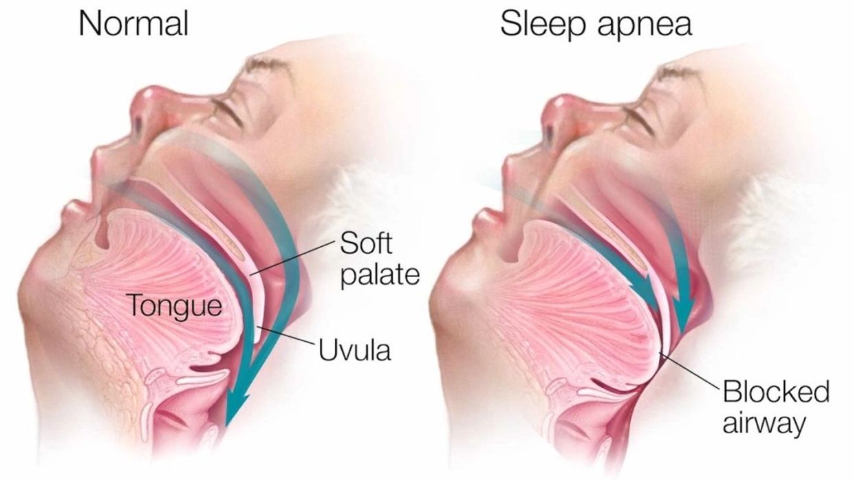 Sleep apnoea mechanism