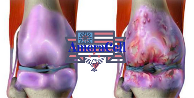 Stem cell clinic,  doctor stem, cell IV infusion hydration  Indianapolis, Indiana fishers Indiana