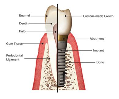 Implant, Extraction, Dentsply Sorona