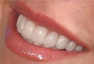 Whitening, Holistic ,Smile ,Brush, Paste ,System, Hydroge Peroxide ,Tooth