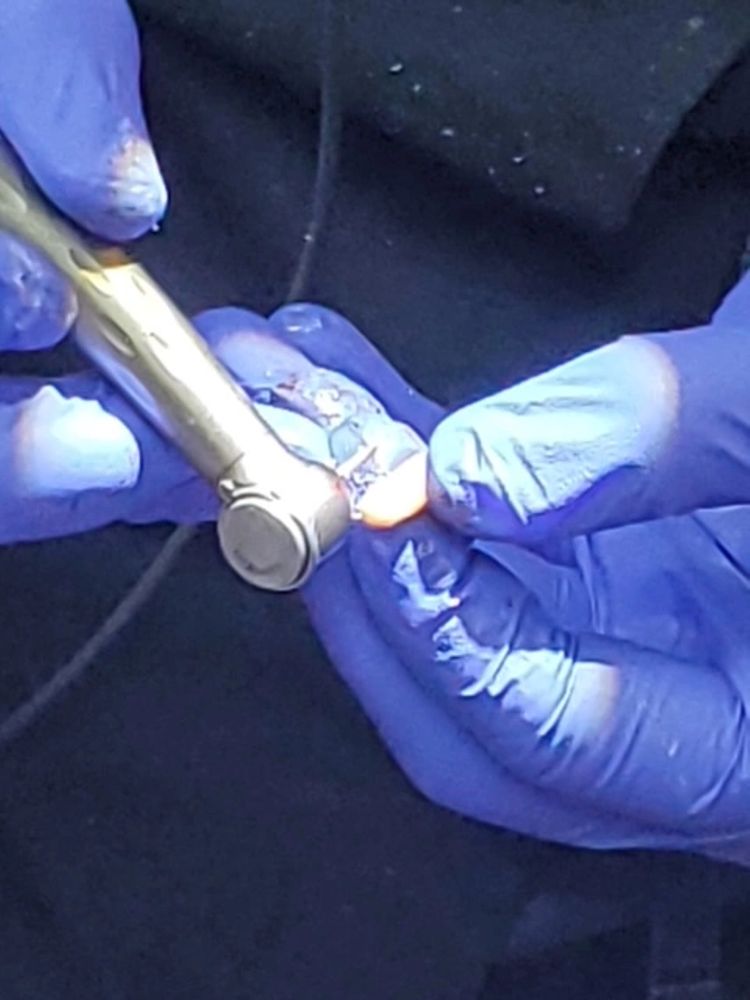 Dentist shaving 3D printed FibreTuff PAPC for inserting into patient