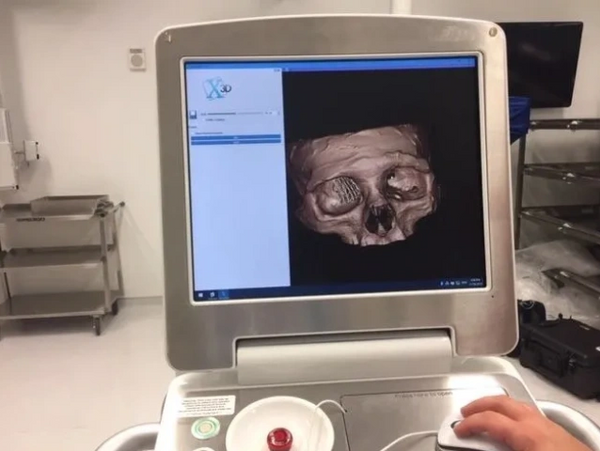 3D Printed Radiographic Image FibreTuff PAPC